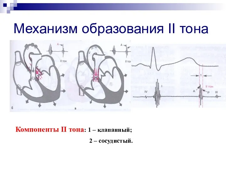 Механизм образования II тона Компоненты II тона: 1 – клапанный; 2 – сосудистый.