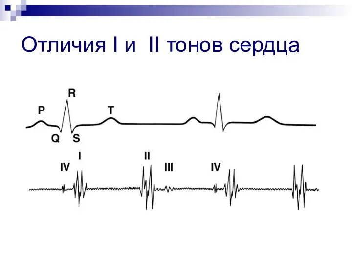 Отличия I и II тонов сердца