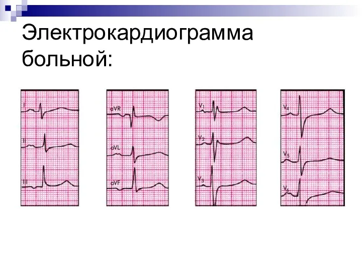 Электрокардиограмма больной: