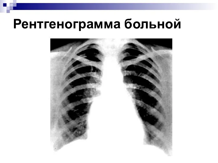 Рентгенограмма больной