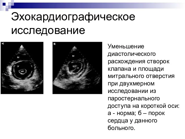 Эхокардиографическое исследование Уменьшение диастолического расхождения створок клапана и площади митрального