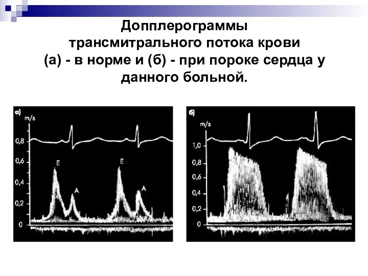 Допплерограммы трансмитрального потока крови (а) - в норме и (б)