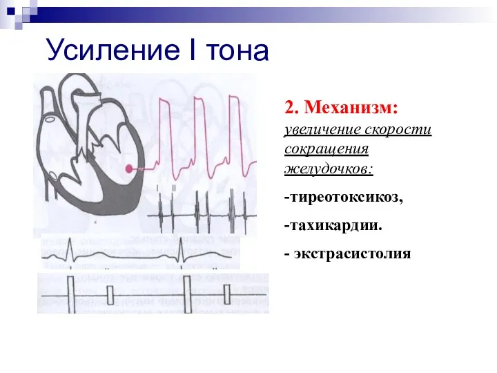 Усиление I тона 2. Механизм: увеличение скорости сокращения желудочков: -тиреотоксикоз, -тахикардии. - экстрасистолия