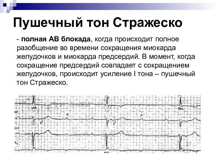 Пушечный тон Стражеско - полная АВ блокада, когда происходит полное