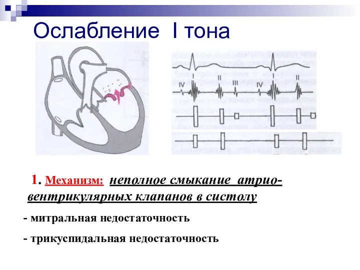 Ослабление I тона 1. Механизм: неполное смыкание атрио-вентрикулярных клапанов в систолу митральная недостаточность трикуспидальная недостаточность