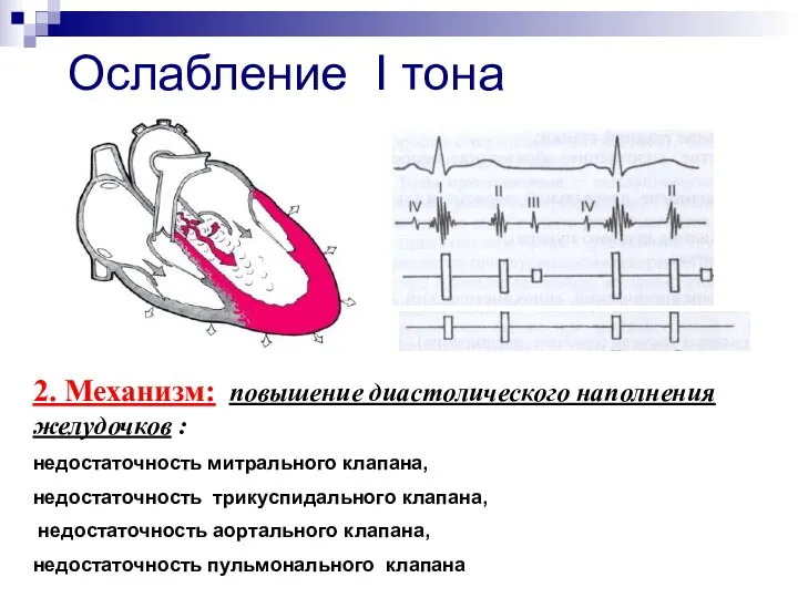 Ослабление I тона 2. Механизм: повышение диастолического наполнения желудочков :