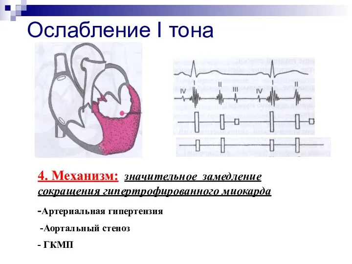 Ослабление I тона 4. Механизм: значительное замедление сокращения гипертрофированного миокарда -Артериальная гипертензия -Аортальный стеноз - ГКМП