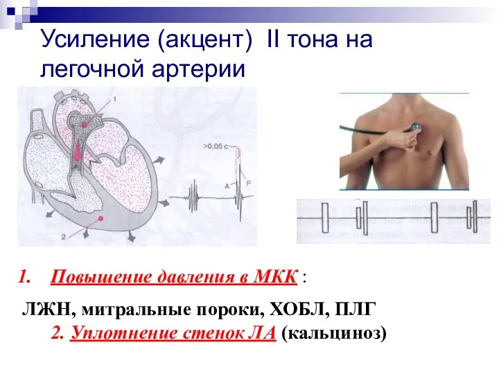 Усиление (акцент) II тона на легочной артерии Повышение давления в