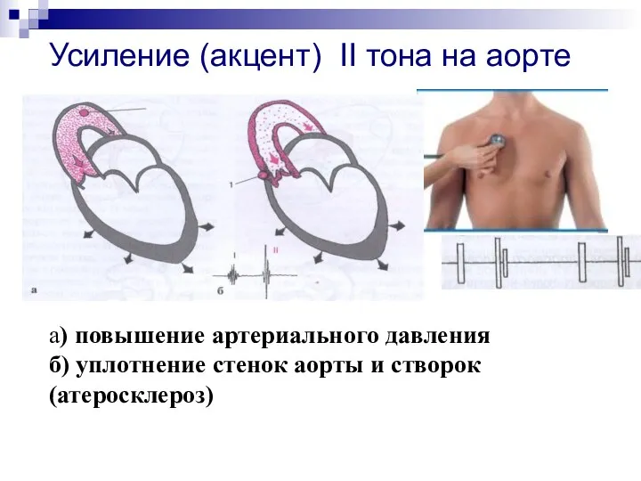 Усиление (акцент) II тона на аорте а) повышение артериального давления