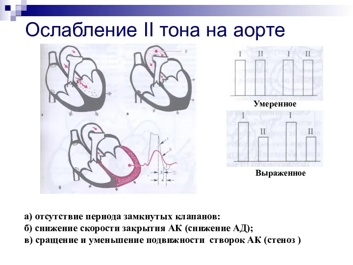 Ослабление II тона на аорте Умеренное Выраженное а) отсутствие периода