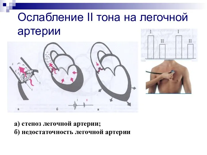 Ослабление II тона на легочной артерии а) стеноз легочной артерии; б) недостаточность легочной артерии