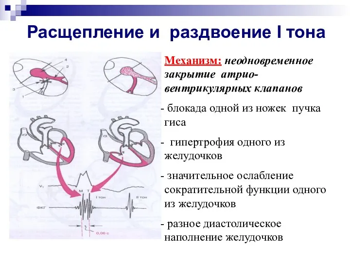 Расщепление и раздвоение I тона Механизм: неодновременное закрытие атрио-вентрикулярных клапанов