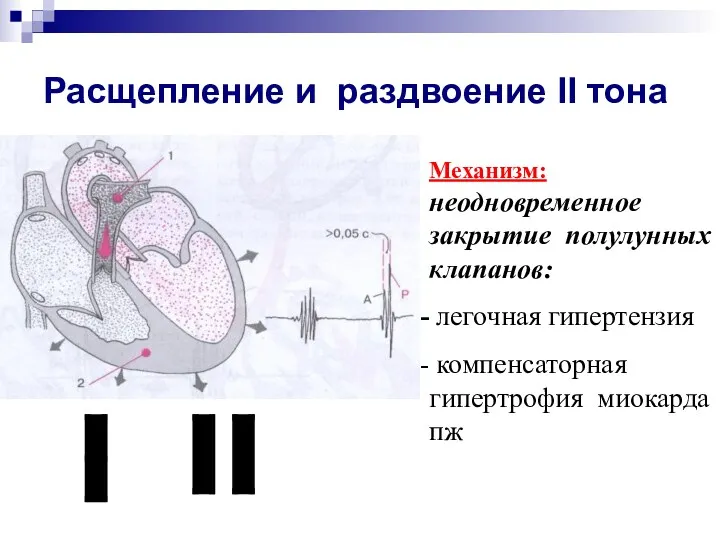 Расщепление и раздвоение II тона Механизм: неодновременное закрытие полулунных клапанов: легочная гипертензия компенсаторная гипертрофия миокарда пж