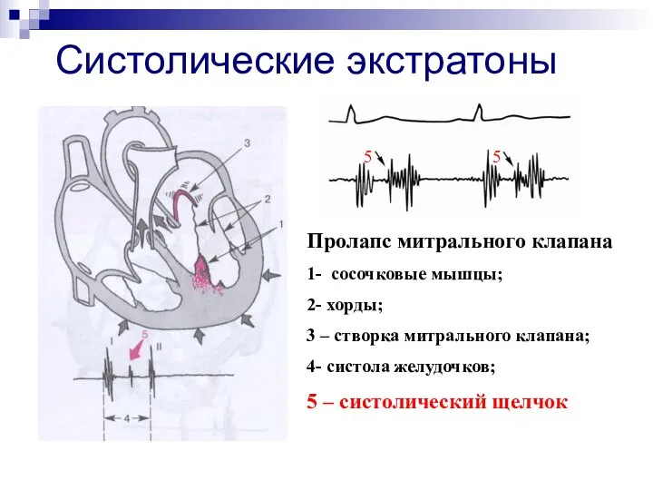 Систолические экстратоны Пролапс митрального клапана 1- сосочковые мышцы; 2- хорды;