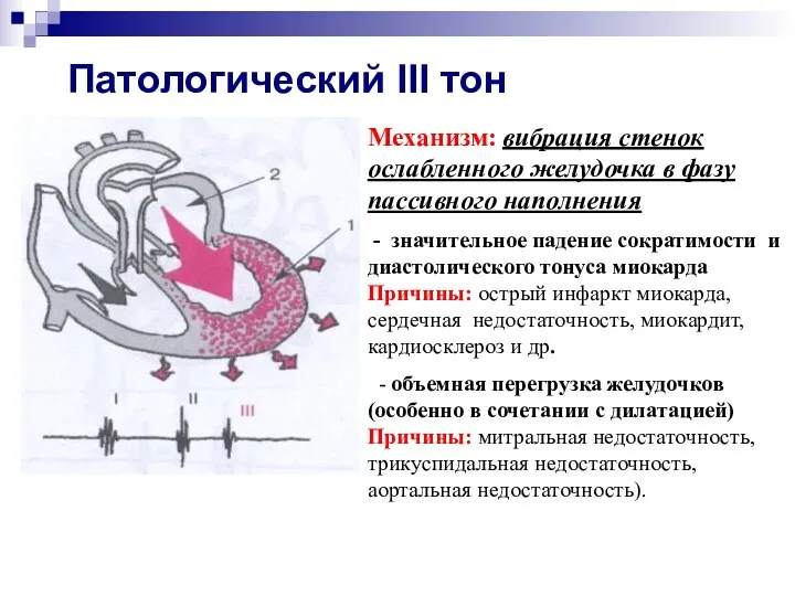 Патологический III тон Механизм: вибрация стенок ослабленного желудочка в фазу