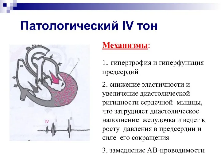 Патологический IV тон Механизмы: 1. гипертрофия и гиперфункция предсердий 2.