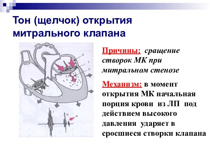 Тон (щелчок) открытия митрального клапана Причины: сращение створок МК при