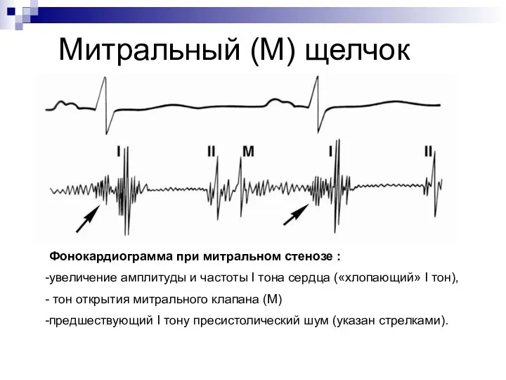 Митральный (М) щелчок Фонокардиограмма при митральном стенозе : увеличение амплитуды