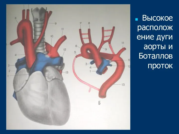 Высокое расположение дуги аорты и Боталлов проток