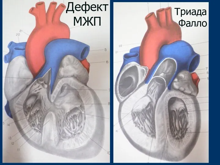 Дефект МЖП Триада Фалло