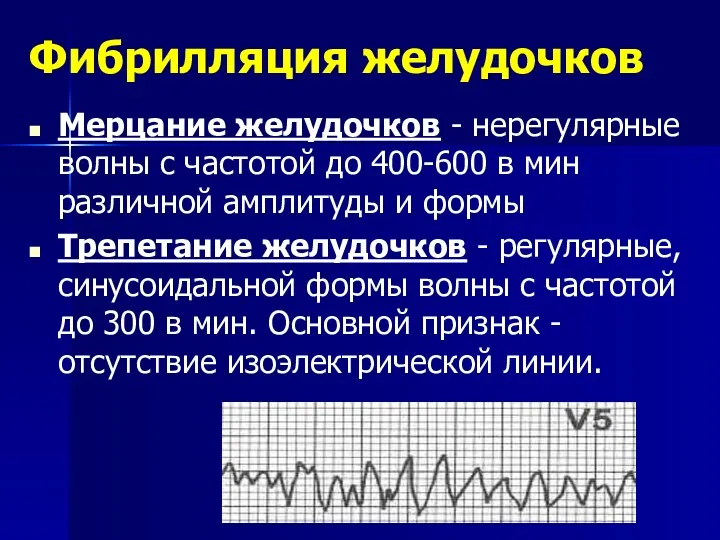 Мерцание желудочков - нерегулярные волны с частотой до 400-600 в мин различной амплитуды