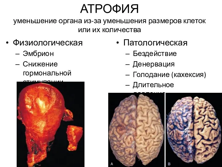 АТРОФИЯ уменьшение органа из-за уменьшения размеров клеток или их количества