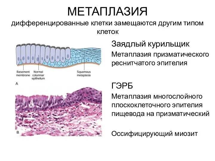 МЕТАПЛАЗИЯ дифференцированные клетки замещаются другим типом клеток Заядлый курильщик Метаплазия