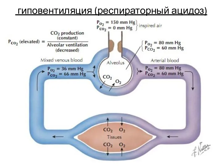 гиповентиляция (респираторный ацидоз)