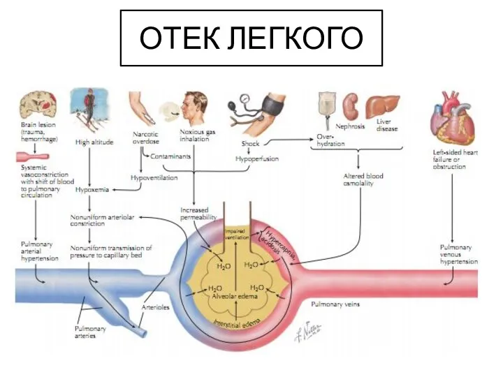 ОТЕК ЛЕГКОГО