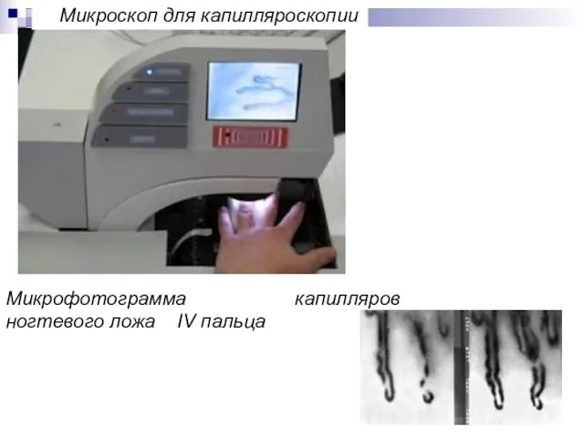Микроскоп для капилляроскопии Микрофотограмма капилляров ногтевого ложа IV пальца