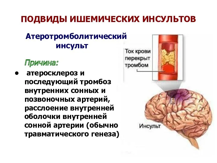 ПОДВИДЫ ИШЕМИЧЕСКИХ ИНСУЛЬТОВ Атеротромболитический инсульт Причина: атеросклероз и последующий тромбоз