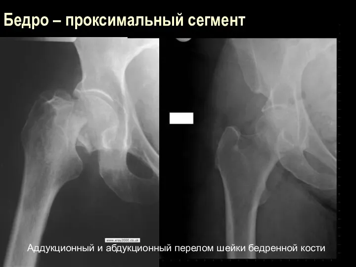 Аддукционный и абдукционный перелом шейки бедренной кости Бедро – проксимальный сегмент