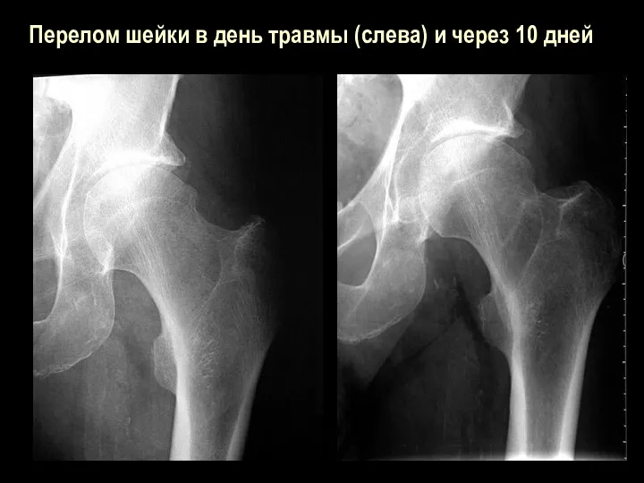Перелом шейки в день травмы (слева) и через 10 дней
