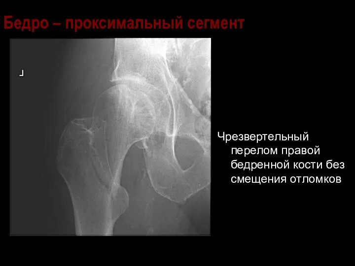 Бедро – проксимальный сегмент Чрезвертельный перелом правой бедренной кости без смещения отломков