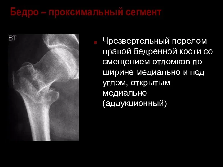 Бедро – проксимальный сегмент Чрезвертельный перелом правой бедренной кости со