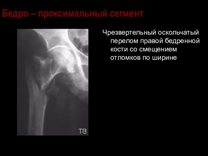 Бедро – проксимальный сегмент Чрезвертельный оскольчатый перелом правой бедренной кости со смещением отломков по ширине