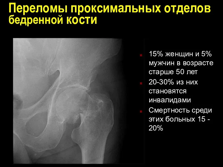 Переломы проксимальных отделов бедренной кости 15% женщин и 5% мужчин