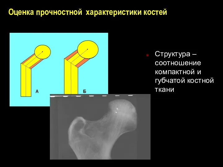 Оценка прочностной характеристики костей Структура – соотношение компактной и губчатой костной ткани