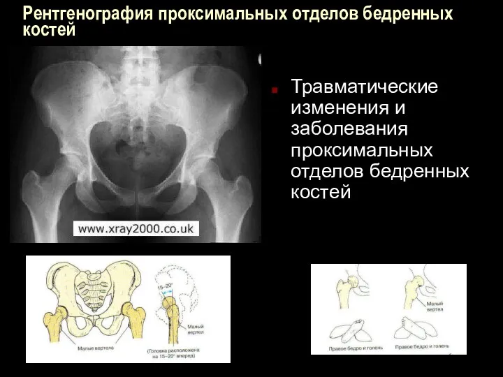 Рентгенография проксимальных отделов бедренных костей Травматические изменения и заболевания проксимальных отделов бедренных костей