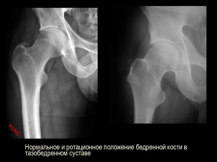 Нормальное и ротационное положение бедренной кости в тазобедренном суставе