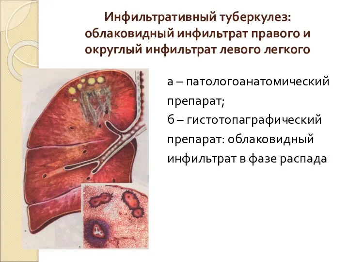 Инфильтративный туберкулез: облаковидный инфильтрат правого и округлый инфильтрат левого легкого