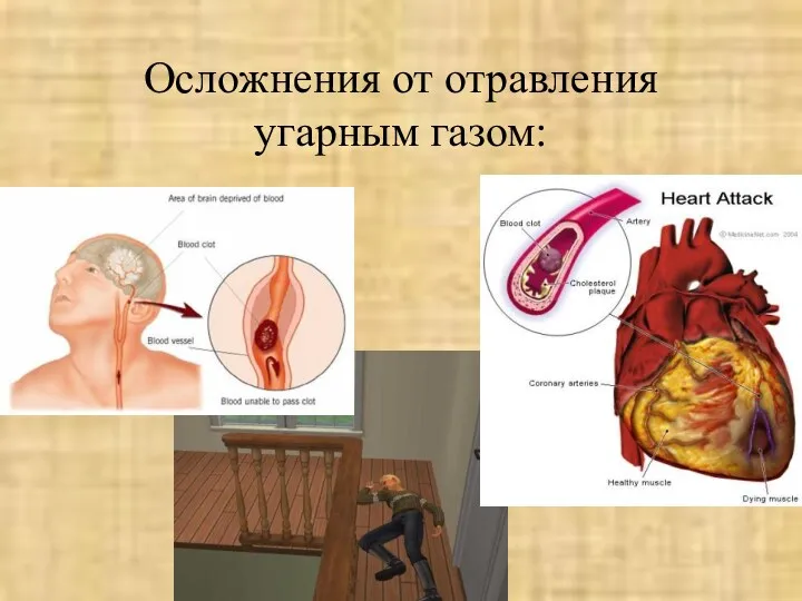 Осложнения от отравления угарным газом: