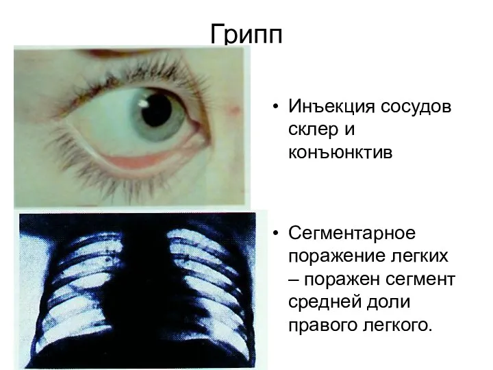 Грипп Инъекция сосудов склер и конъюнктив Сегментарное поражение легких – поражен сегмент средней доли правого легкого.