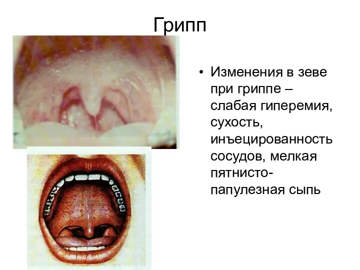 Грипп Изменения в зеве при гриппе – слабая гиперемия, сухость, инъецированность сосудов, мелкая пятнисто-папулезная сыпь