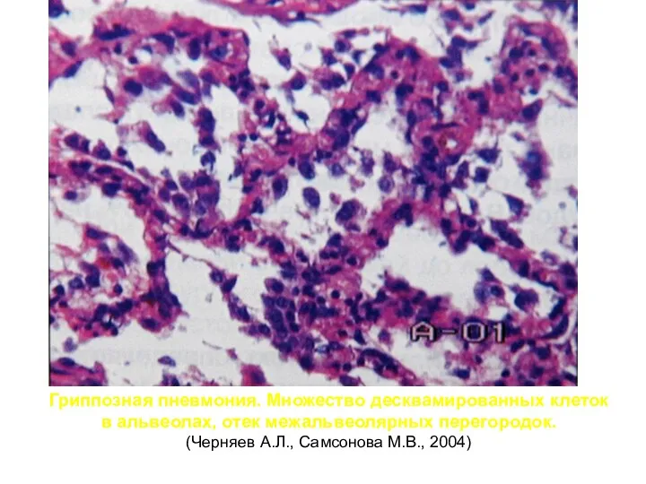 Гриппозная пневмония. Множество десквамированных клеток в альвеолах, отек межальвеолярных перегородок. (Черняев А.Л., Самсонова М.В., 2004)