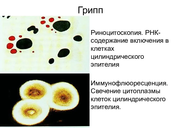 Грипп Риноцитоскопия. РНК-содержание включения в клетках цилиндрического эпителия Иммунофлюоресценция. Свечение цитоплазмы клеток цилиндрического эпителия.