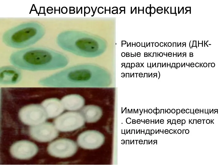 Аденовирусная инфекция Риноцитоскопия (ДНК-овые включения в ядрах цилиндрического эпителия) Иммунофлюоресценция. Свечение ядер клеток цилиндрического эпителия