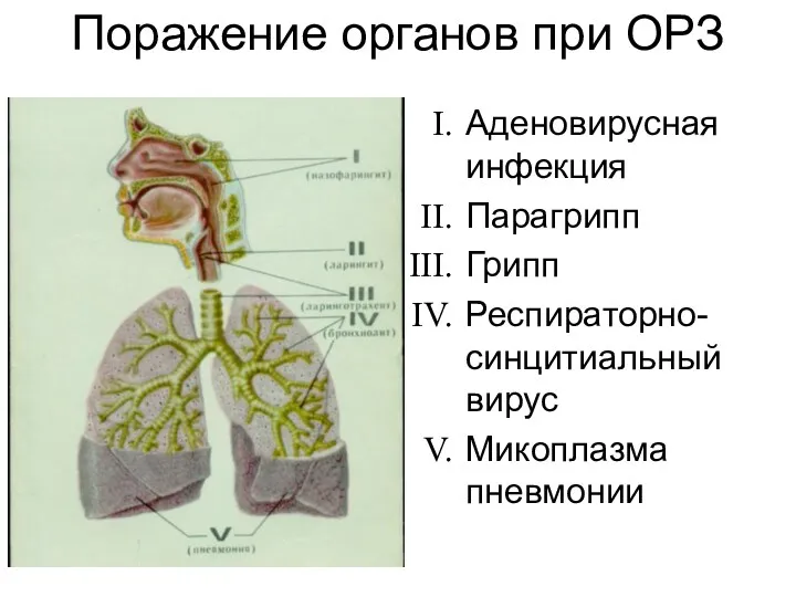 Поражение органов при ОРЗ Аденовирусная инфекция Парагрипп Грипп Респираторно-синцитиальный вирус Микоплазма пневмонии