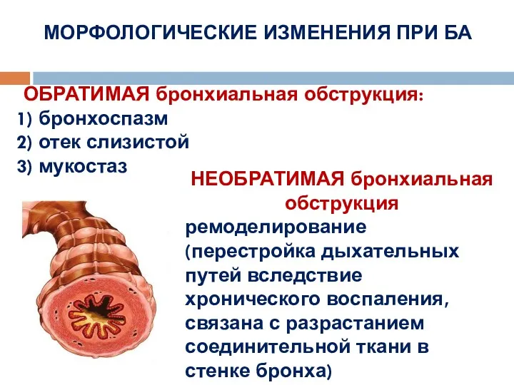 МОРФОЛОГИЧЕСКИЕ ИЗМЕНЕНИЯ ПРИ БА ОБРАТИМАЯ бронхиальная обструкция: бронхоспазм отек слизистой