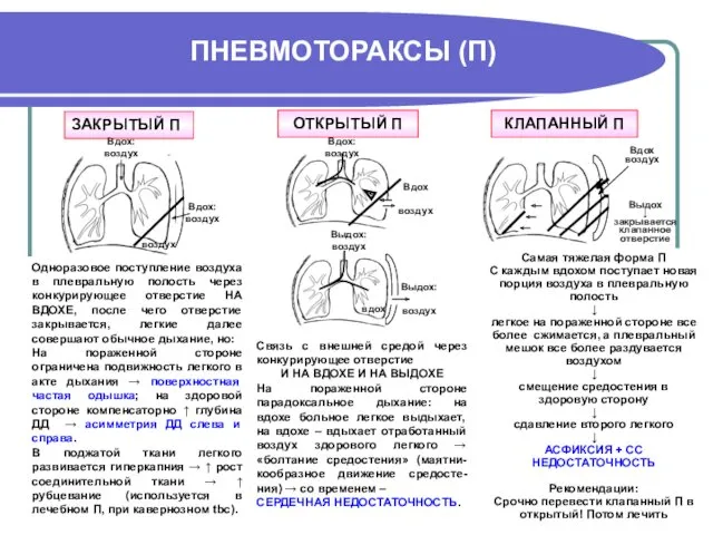 ПНЕВМОТОРАКСЫ (П) ОТКРЫТЫЙ П КЛАПАННЫЙ П ЗАКРЫТЫЙ П Одноразовое поступление